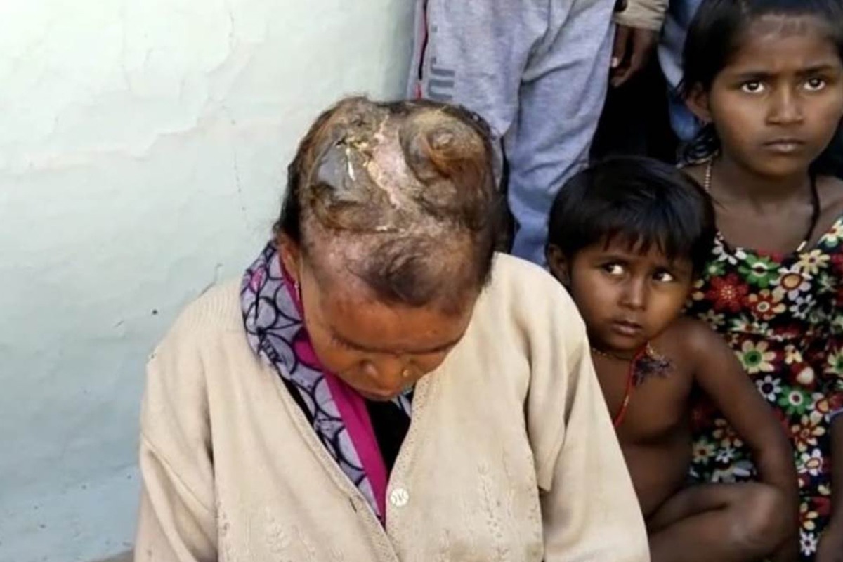Sixty-year-old Mimiya Bai Kori has been suffering from a rare illness in which she has developed a painful protuberance on her head. These protuberances look just like horns growing out of her head. These ‘horns’ have been growing slowly over the past three years.